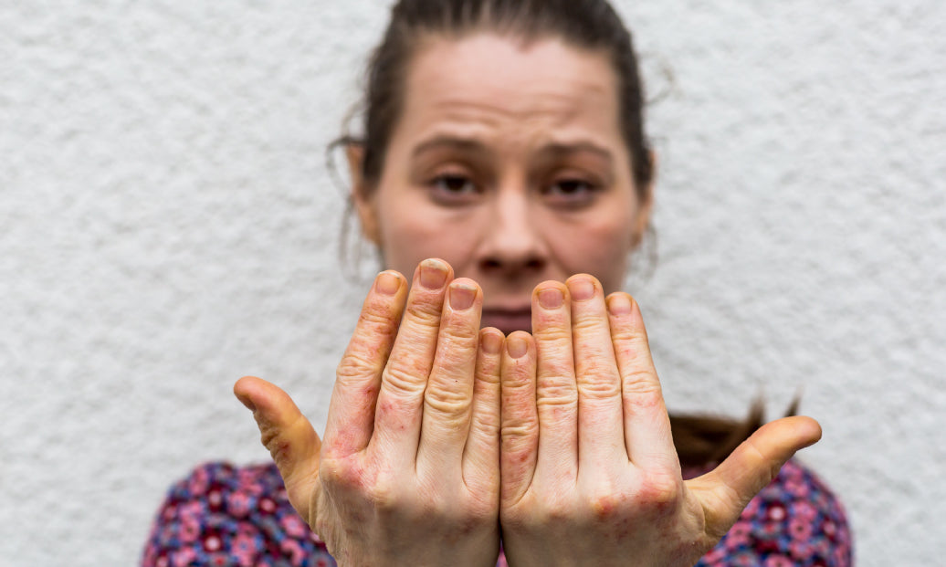 eczema on hands