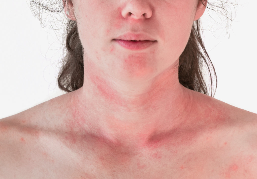 Example of skin flaring up and going red around the neck