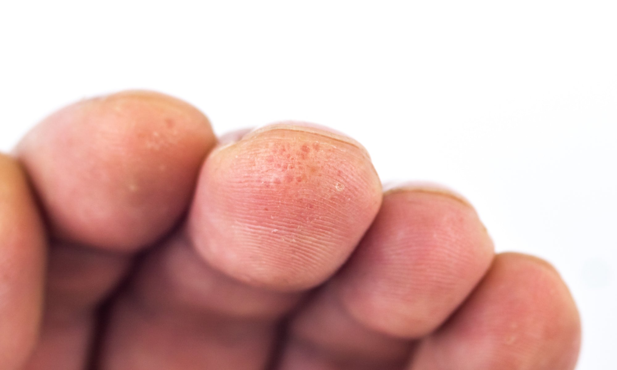 Dyshidrotic Eczema at the tip of fingers