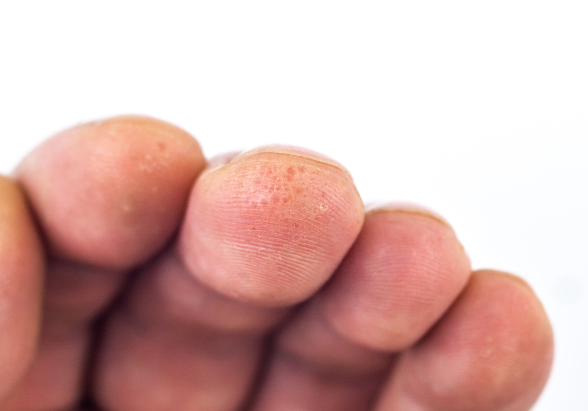 Dyshidrotic Eczema at the tip of fingers