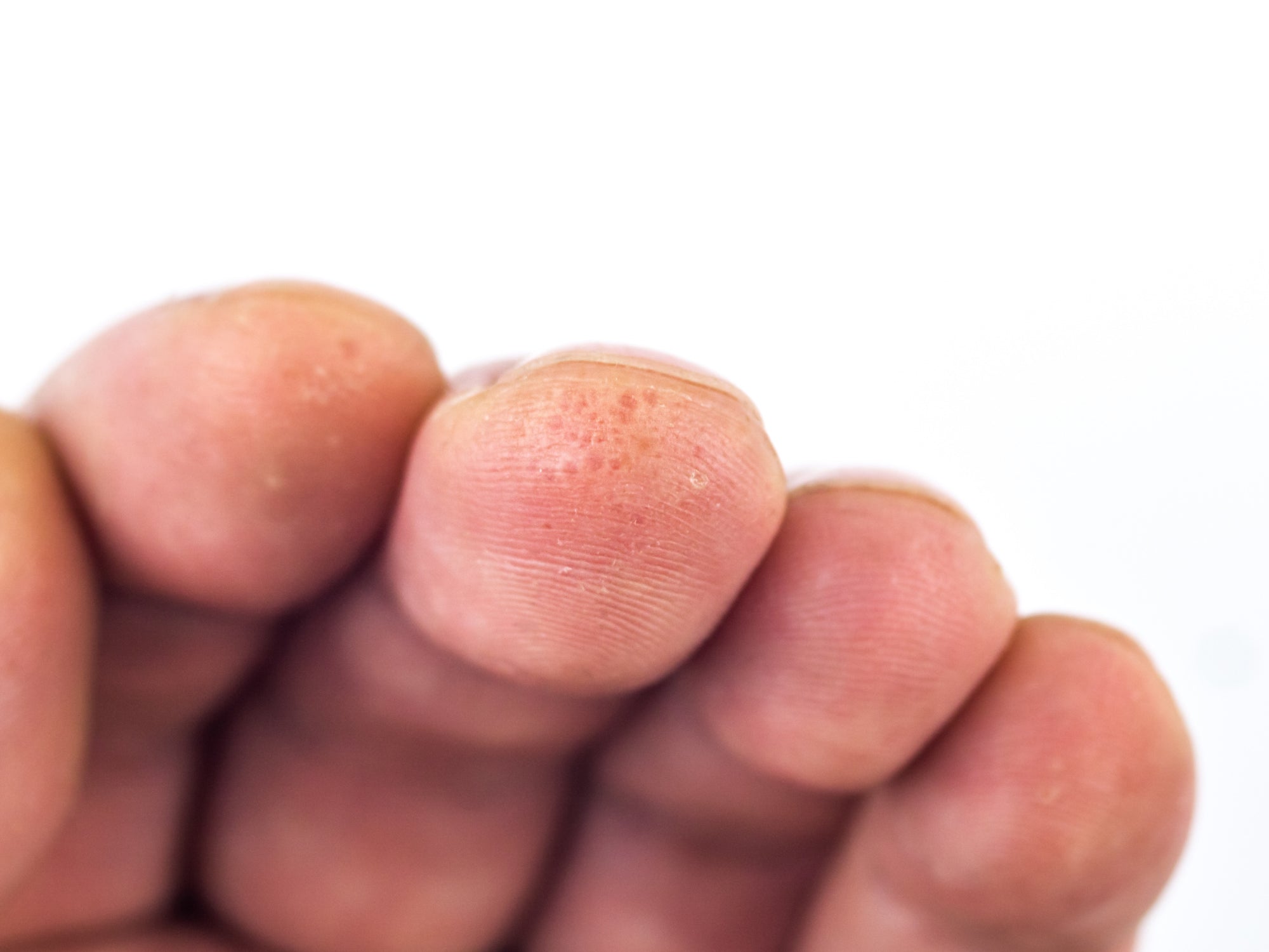 Fingertips Eczema Fingertips Closeup Of Eczema Dermatitis On Man Hand And