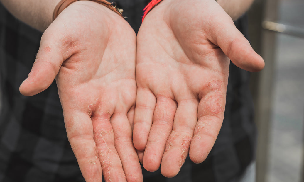 Dyshidrosis on palms of hands