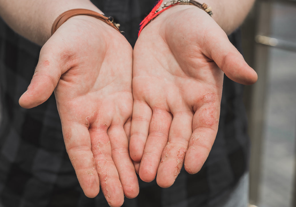 Dyshidrosis on palms of hands