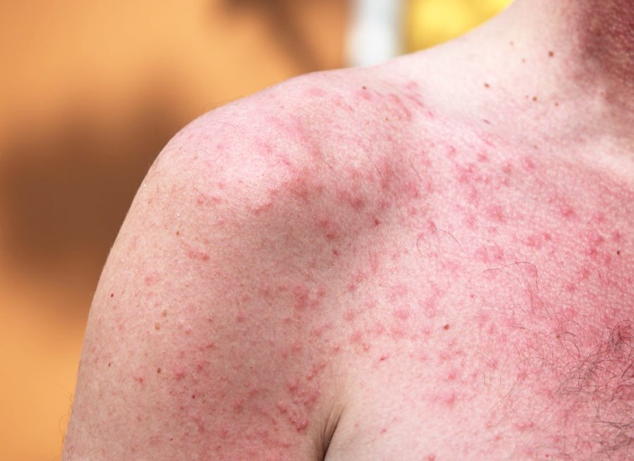 Is Polymorphic Light Eruption Serious? – Balmonds