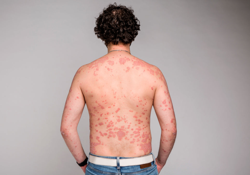 psoriasis on a torso