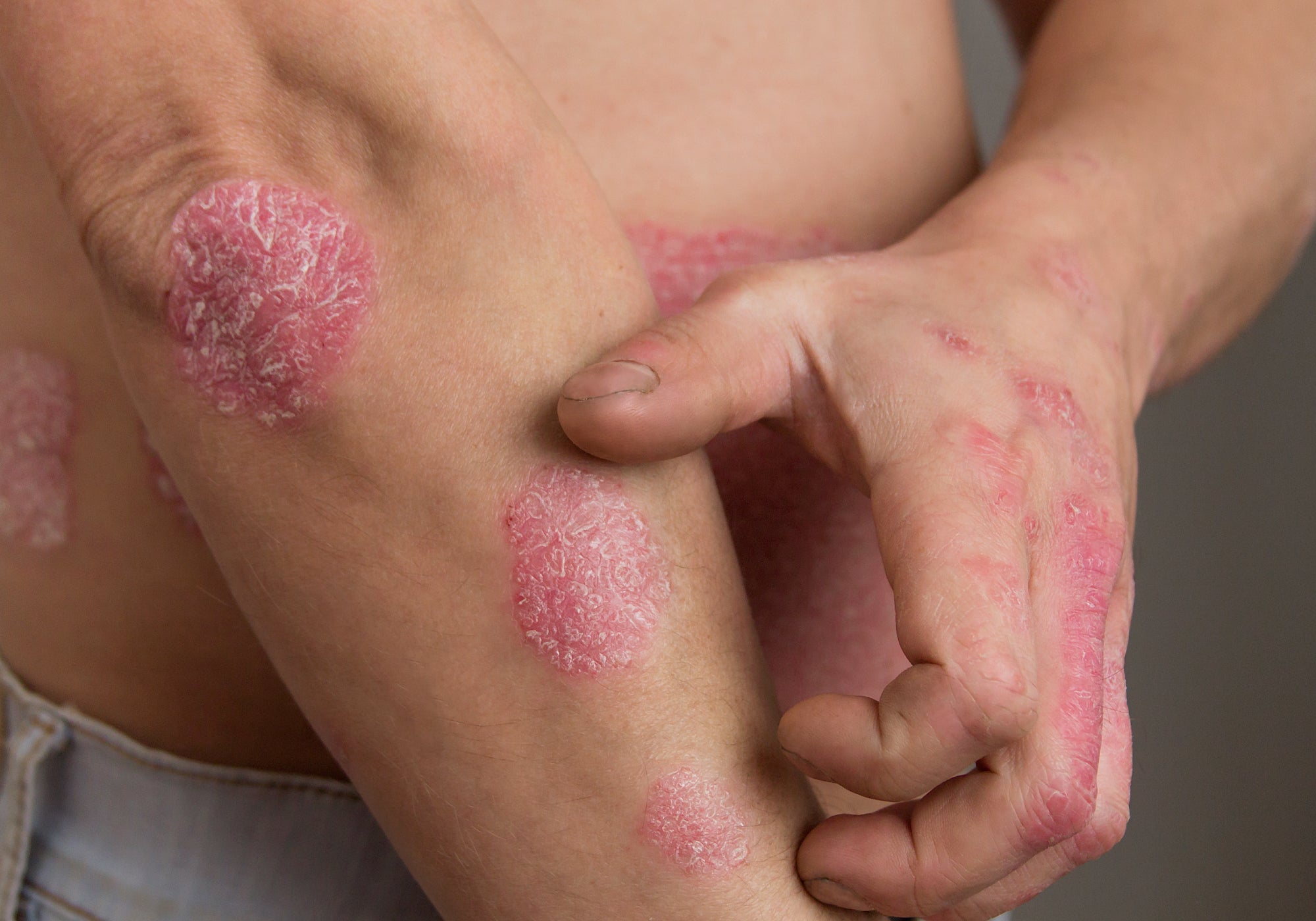 scratching psoriasis on lower arm