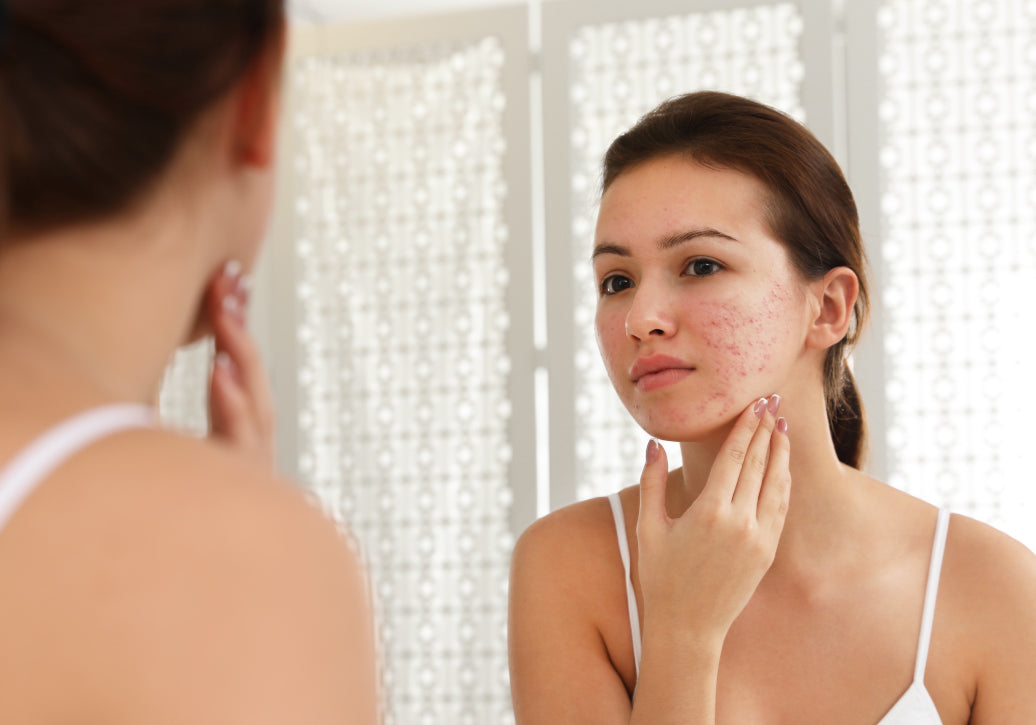 looking into a mirror checking rosacea