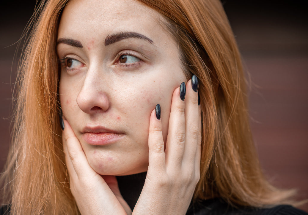 example of rosacea