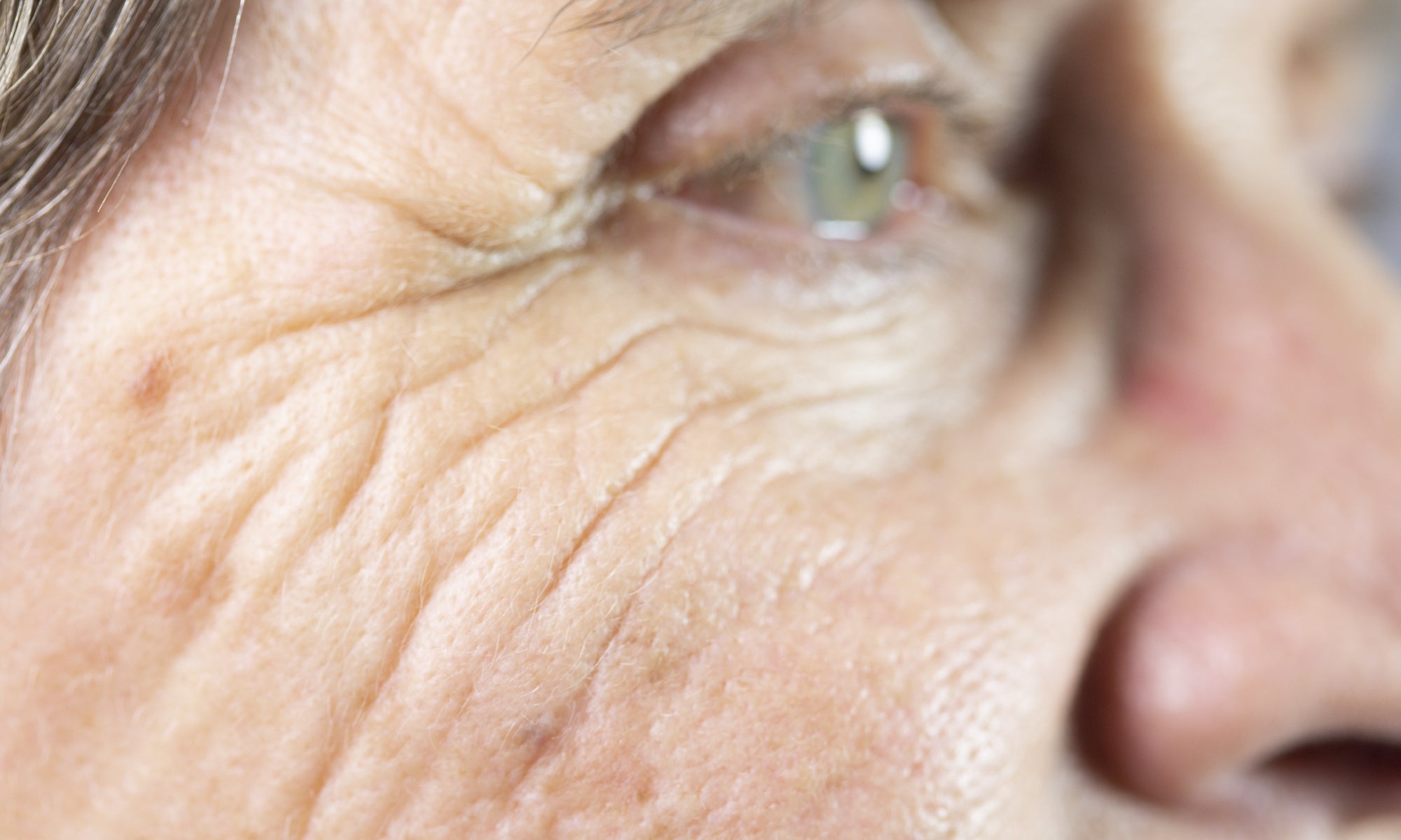 Actinic Keratosis on the side of the face and around the eye