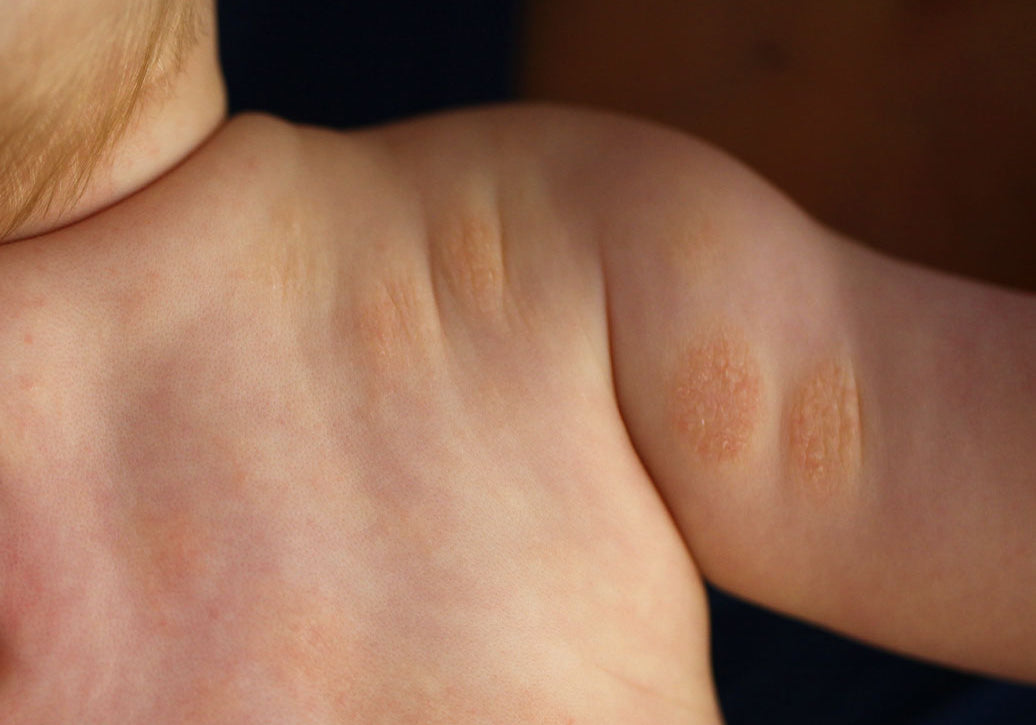 Is Discoid Eczema An Autoimmune Disease?