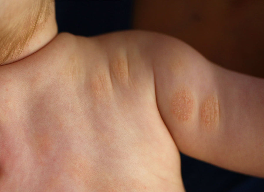 Is Discoid Eczema An Autoimmune Disease?