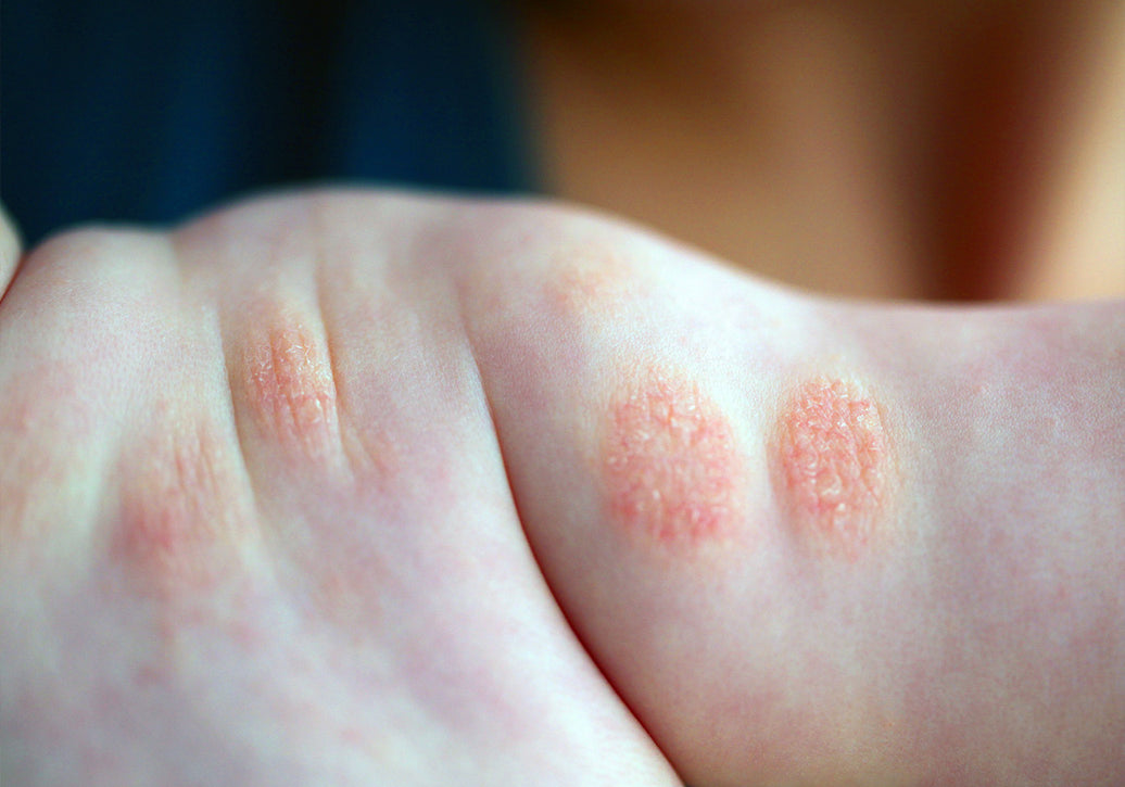 Is Discoid Eczema Contagious?