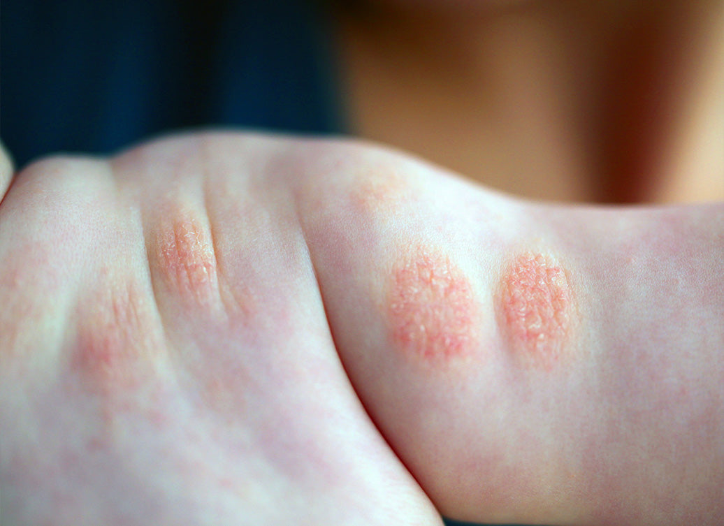 Is Discoid Eczema Contagious? – Balmonds