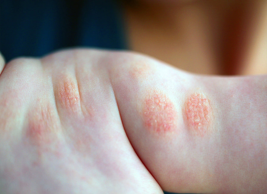 Is Discoid Eczema Contagious?