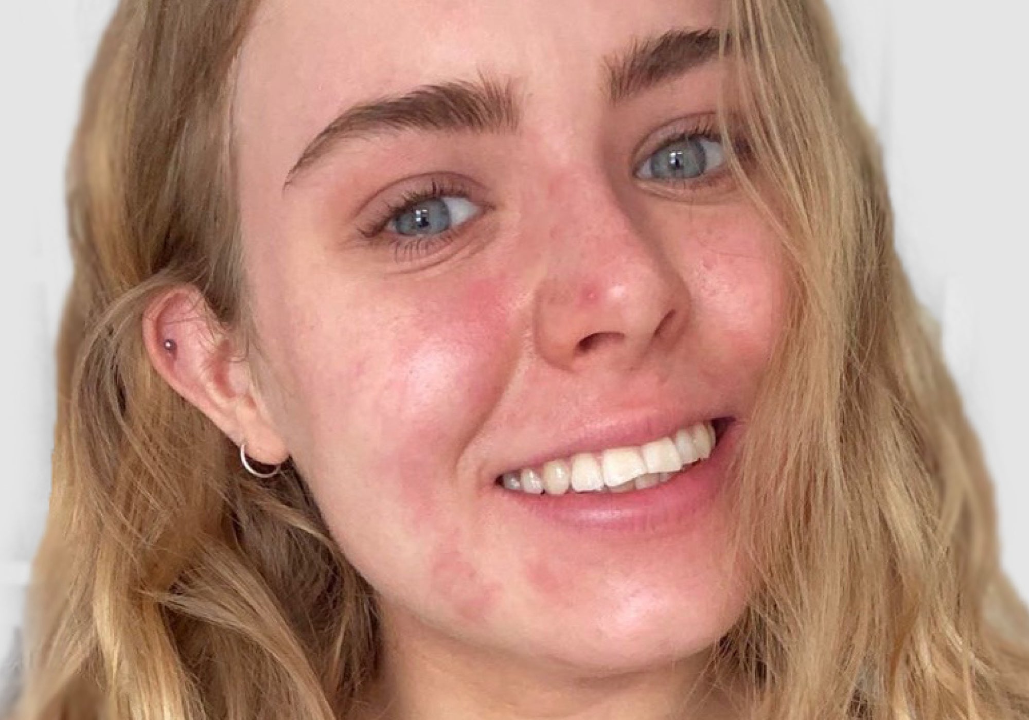 Topical Steroid Withdrawl (TSW) & Eczema: Looking After My Skin Naturally