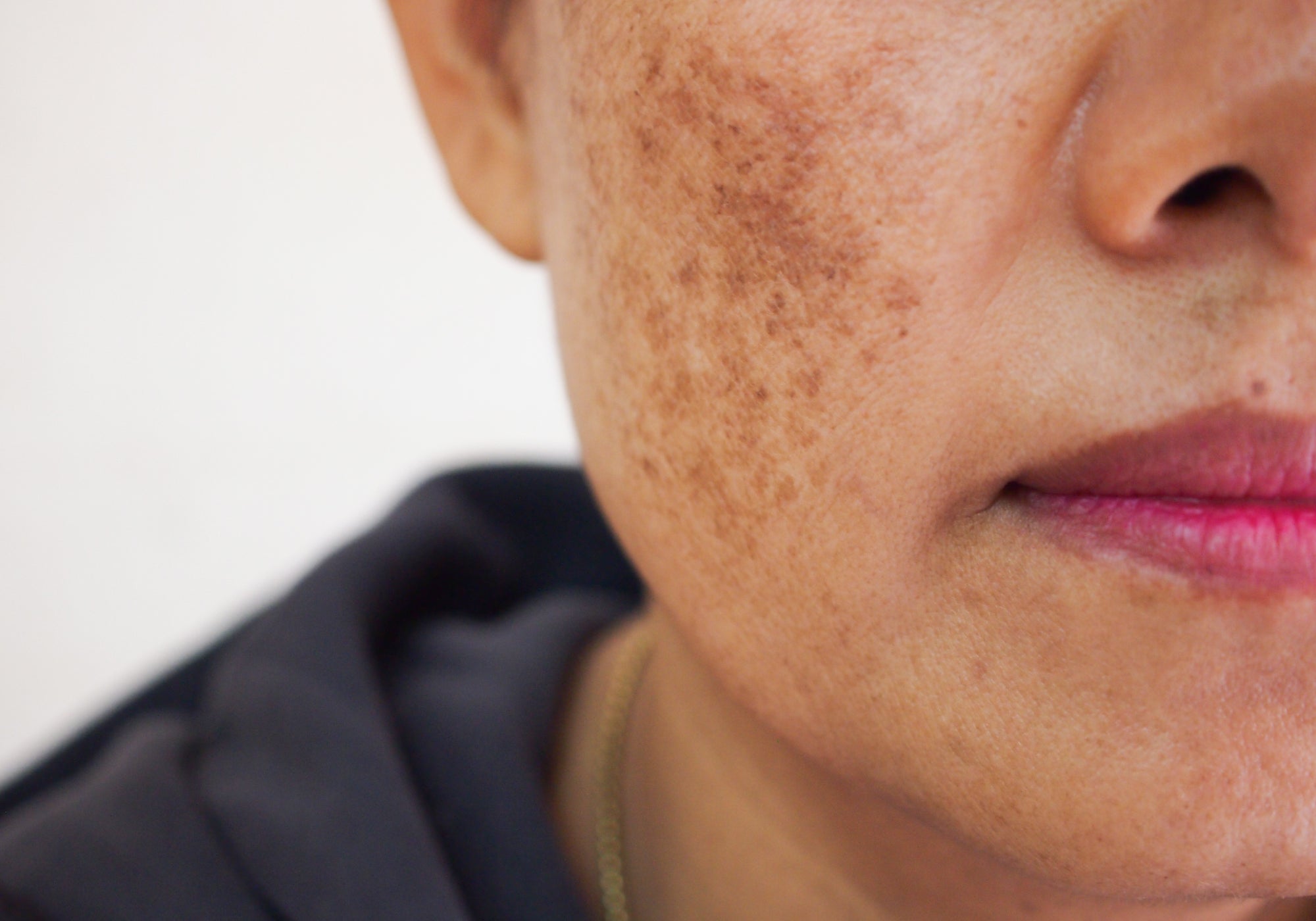 What's The Best Treatment For Melasma?