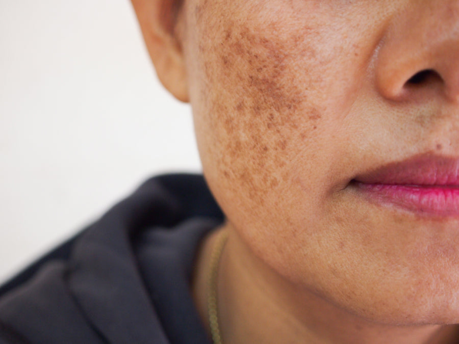 What's The Best Treatment For Melasma?