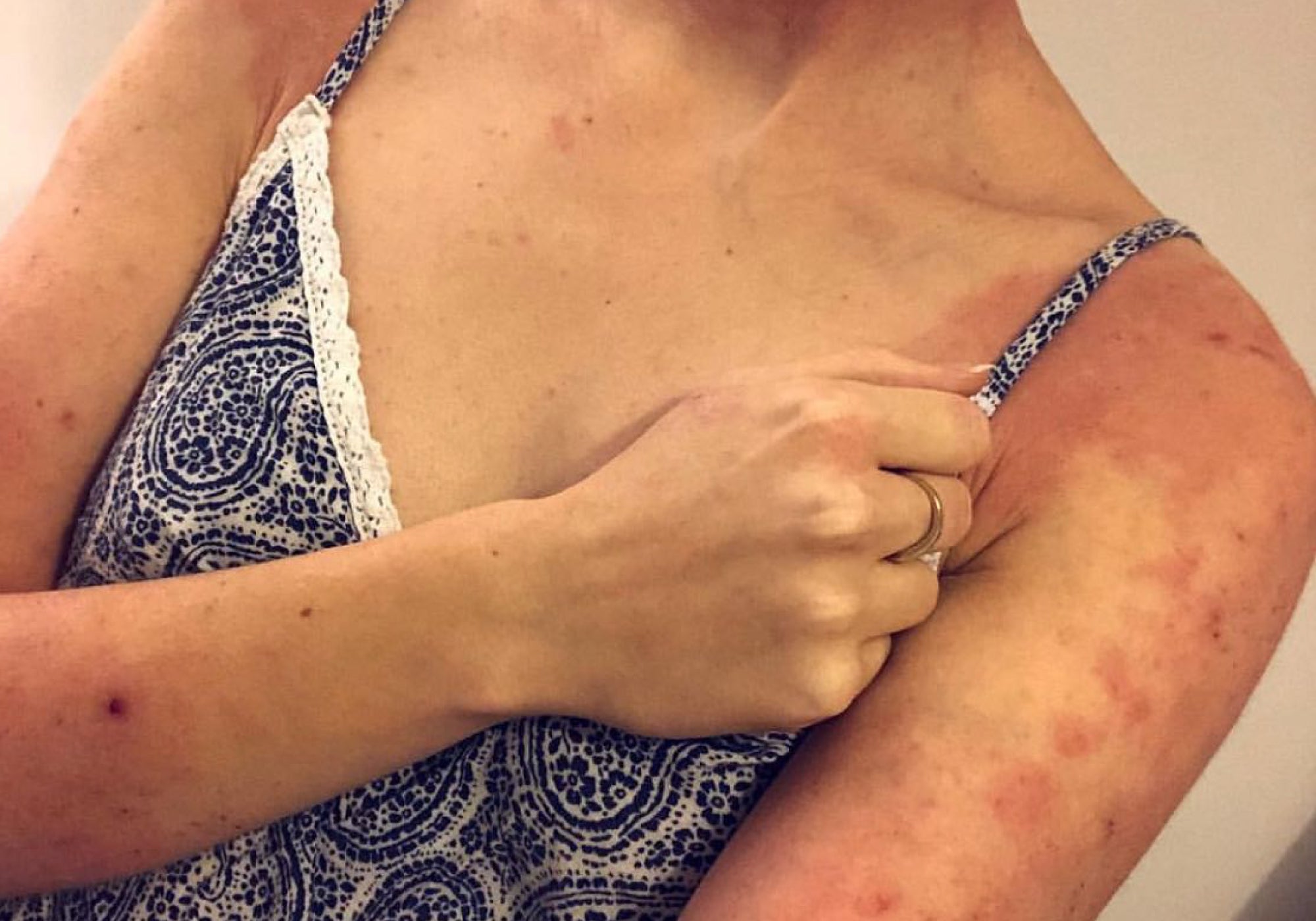 What is No Moisture Treatment Protocol for Topical Steroid Withdrawal?
