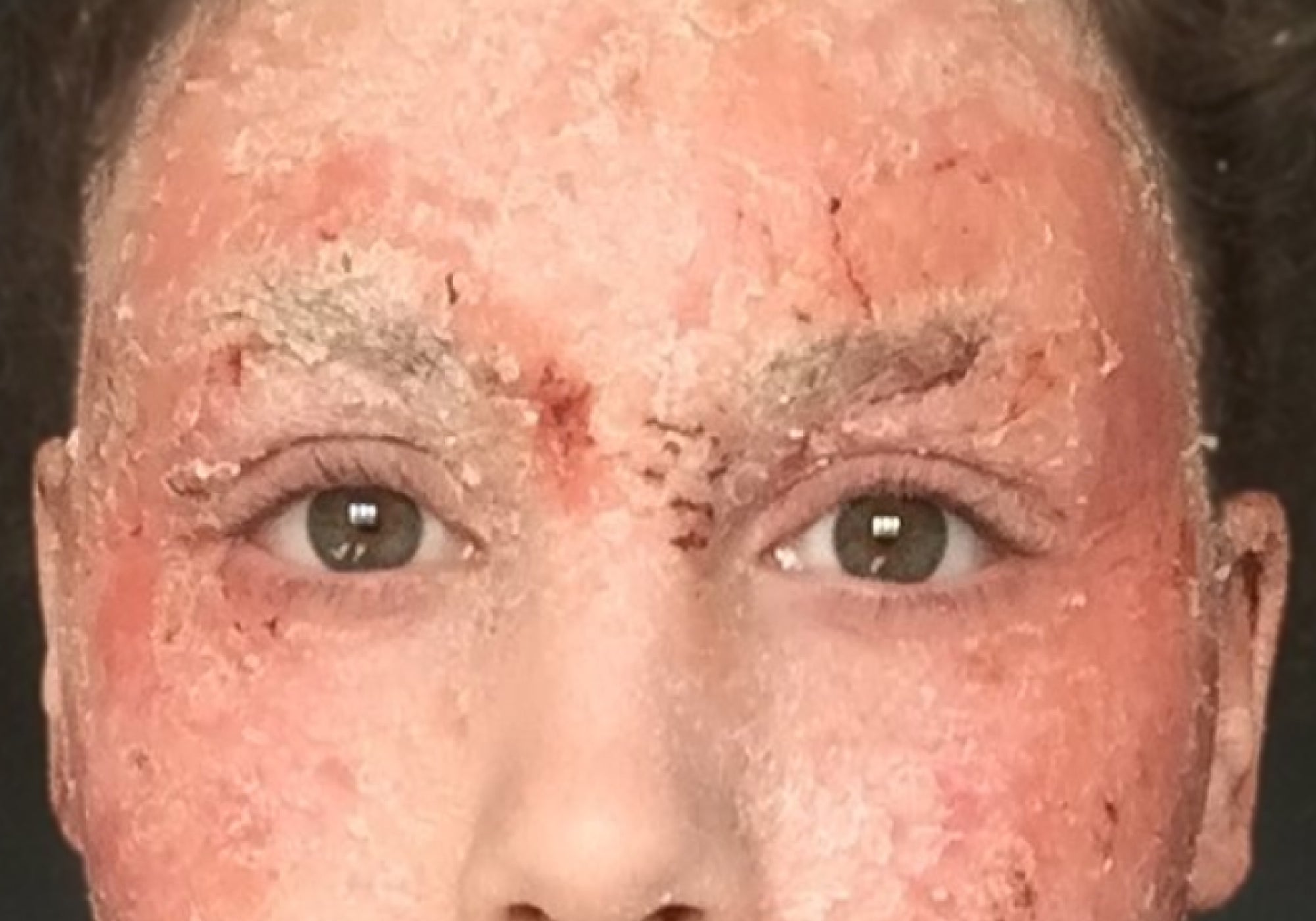 Can No Moisture Treatment (NMT) Speed Up Topical Steroid WIthdrawal?