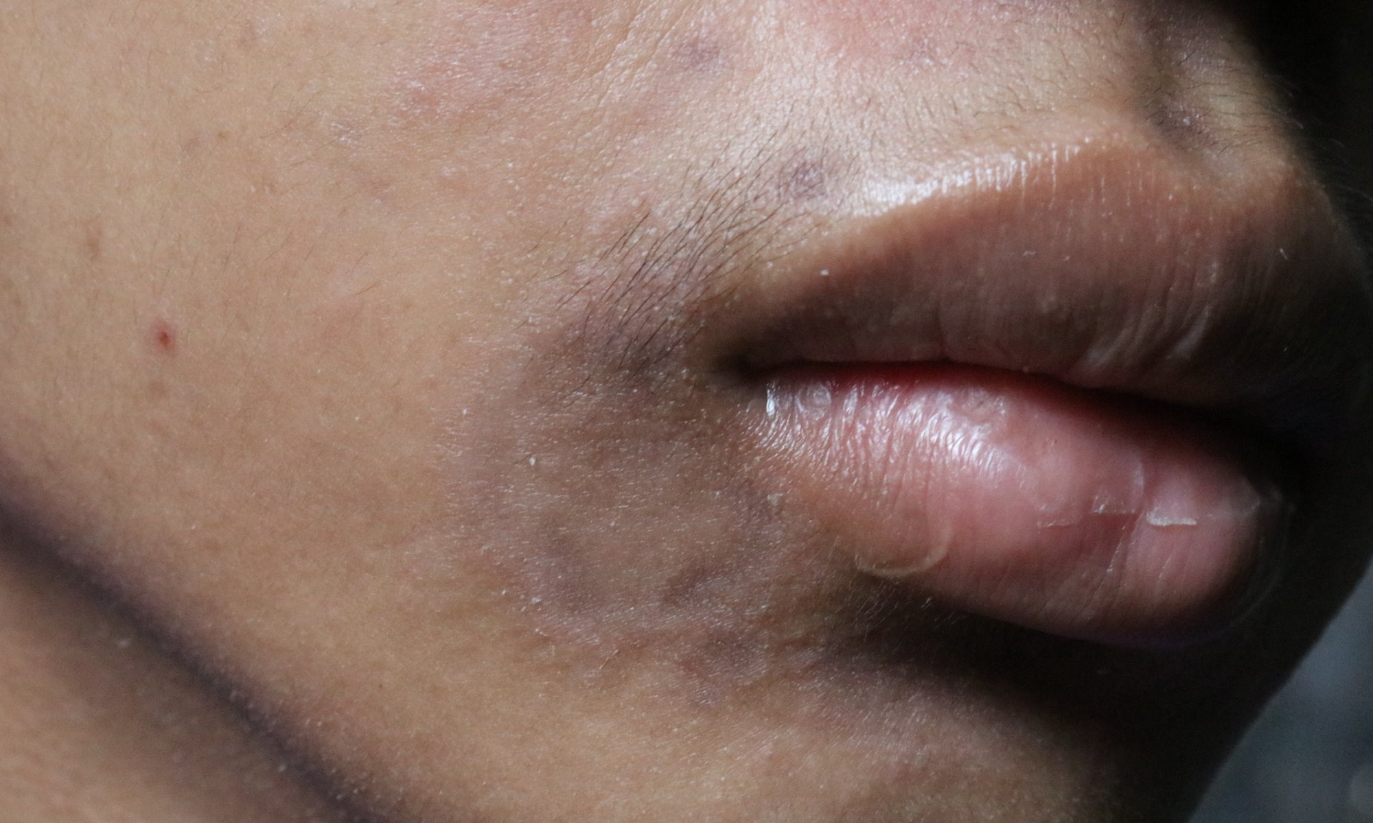 Is Post-Inflammatory Hyperpigmentation Dangerous?