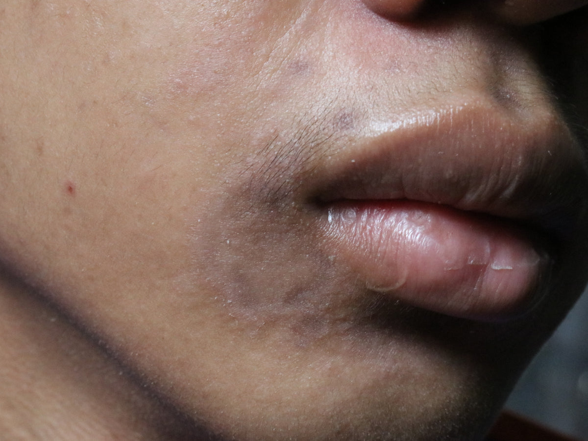 Hyperpigmentation Post Rash Is Post-Inflammatory Hyperpigmentation Dangerous? – Balmonds