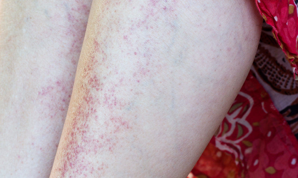 An example of Polymorphic Light Eruption 