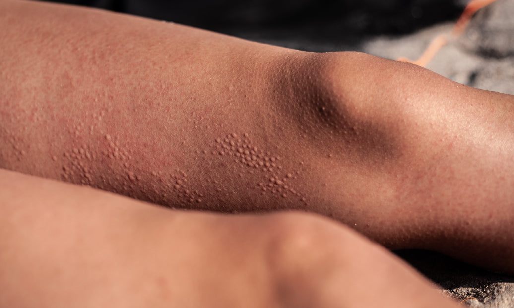 Polymorphous Light Eruption on legs