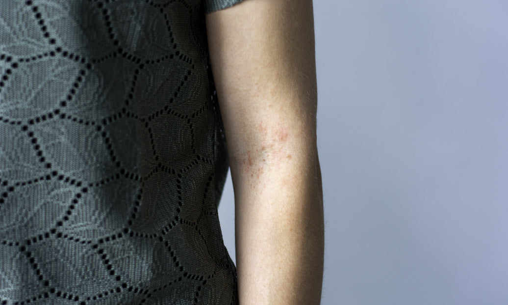 Polymorphic Light Eruption on arm