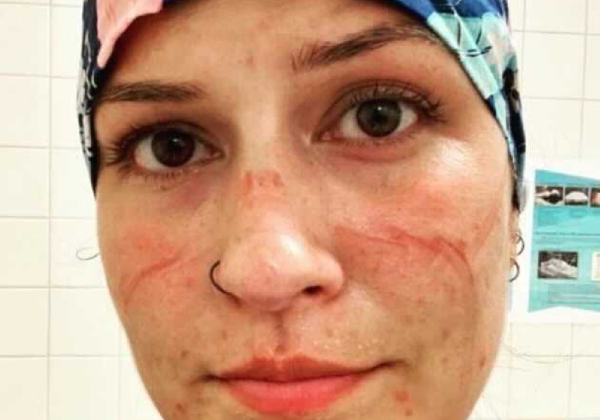 healthworker with sores from wearing PPE