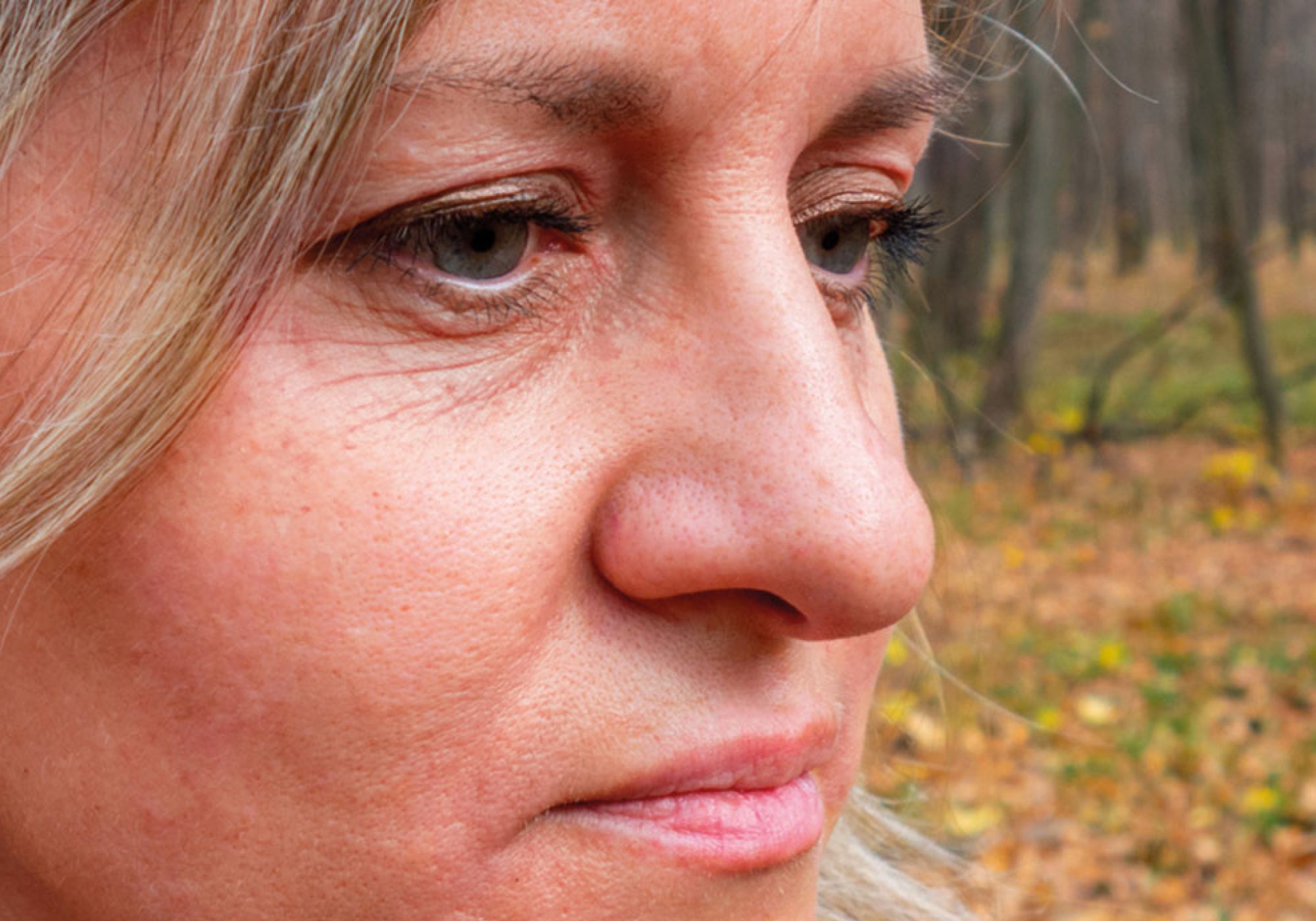 Red Skin Syndrome Or Topical Steroid Withdrawl (TSW): What's The Difference?