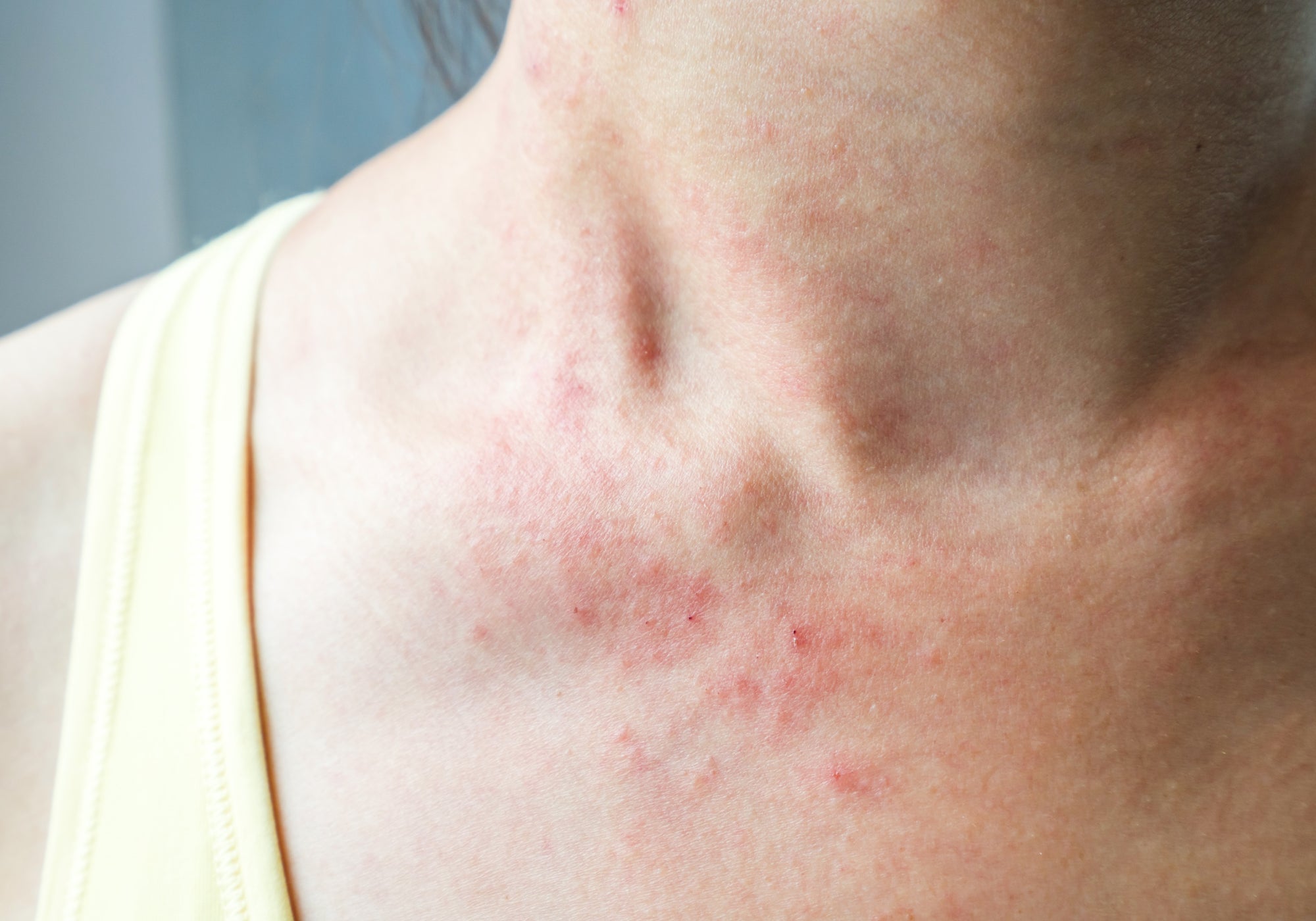 Almonds Skin Rash Chemotherapy – Balmonds