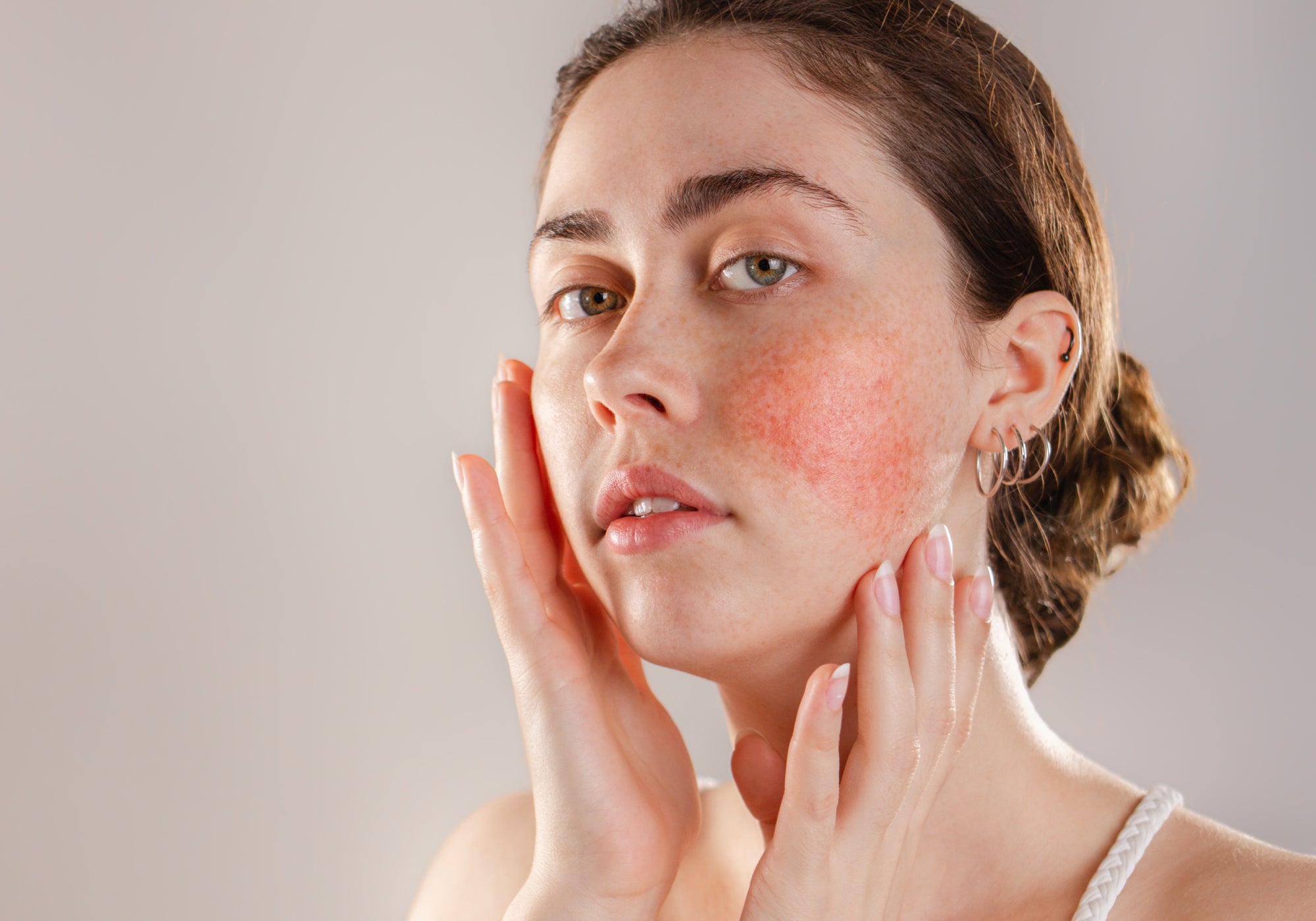 Rosacea Awareness Month