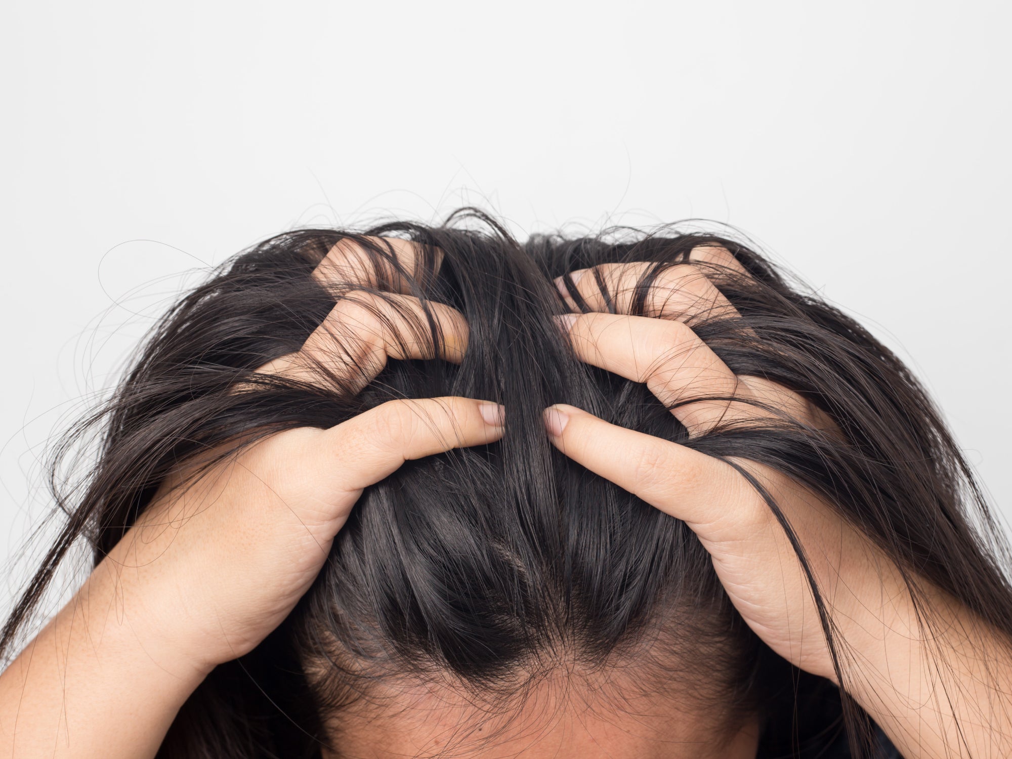 Top 5 Triggers Of Scalp Psoriasis 