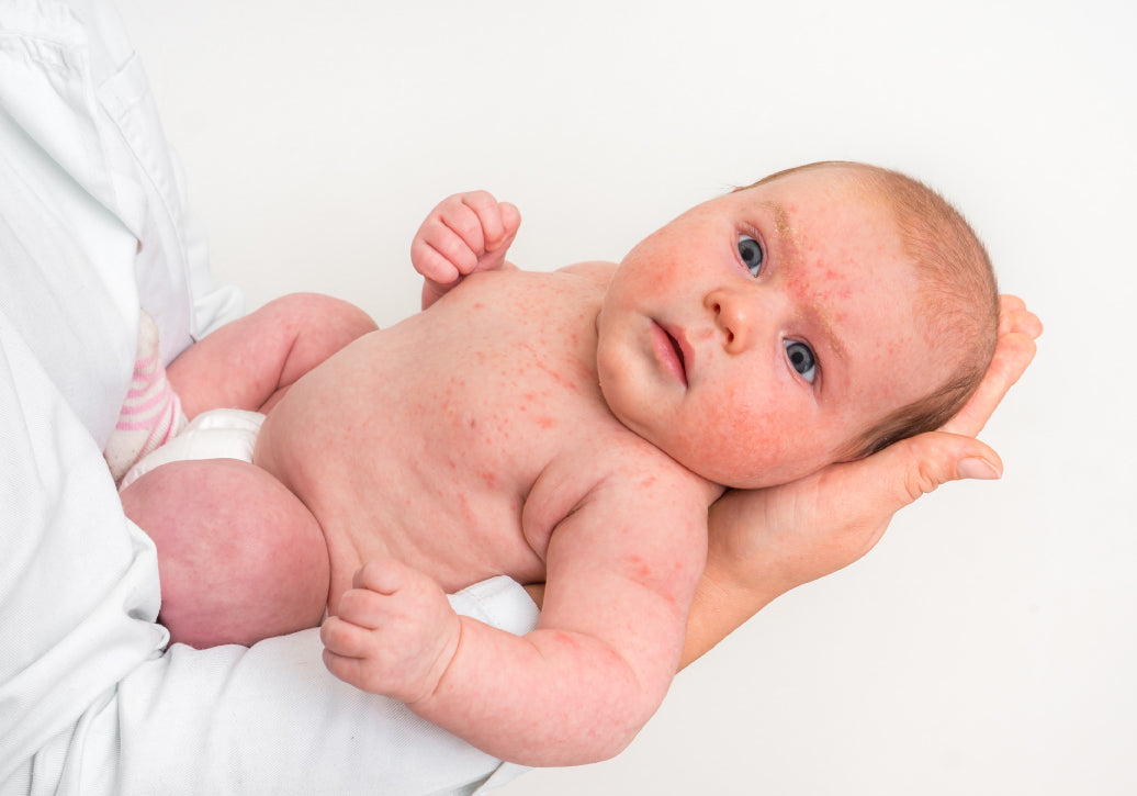 a baby with eczema