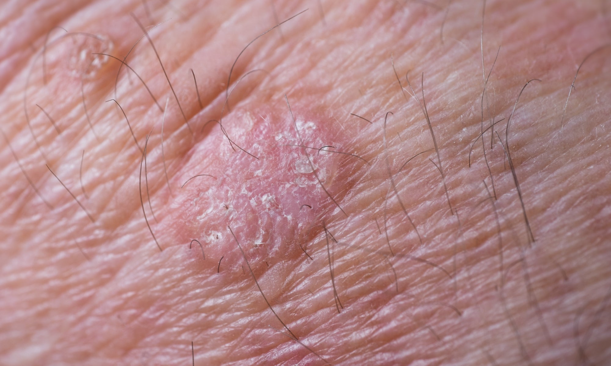 an example of keratosis on the skin