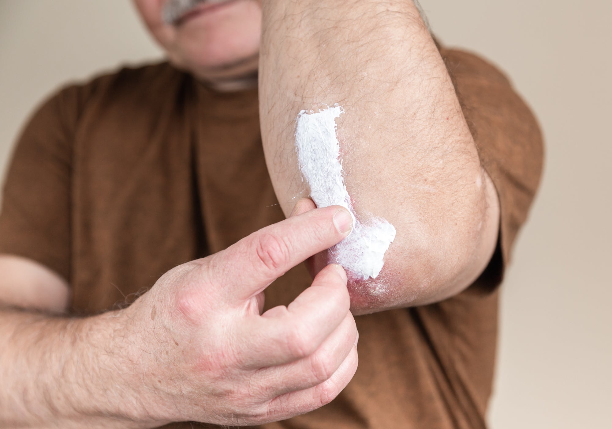 applying lotion to dermatitis