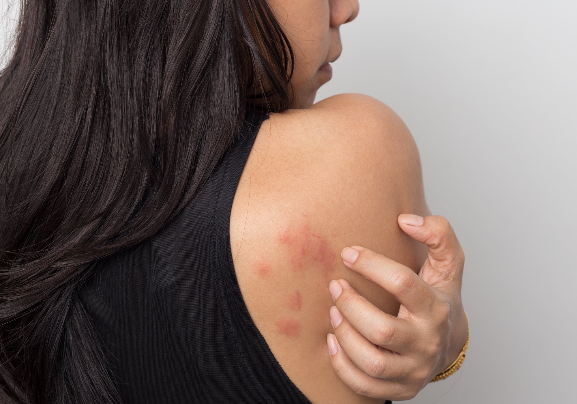 What Does Stress Rash Look Like?