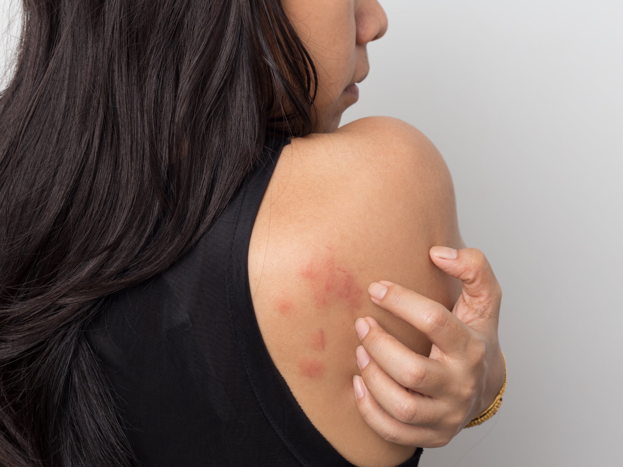 What Does Stress Rash Look Like?