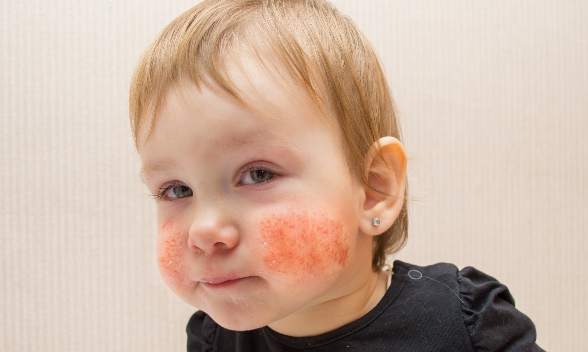 Best Natural Non-Sting Cream For Perioral Dermatitis In Toddlers