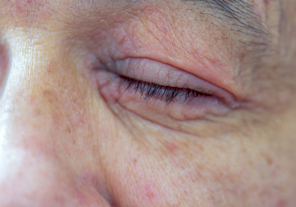 An eye with Periocular Dermatitis around it