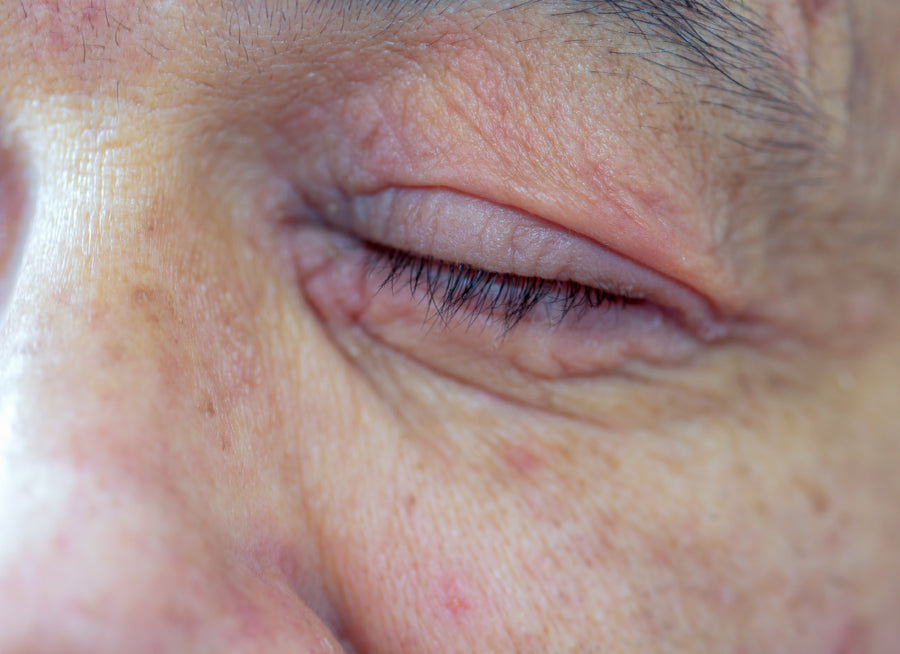 An eye with Periocular Dermatitis around it