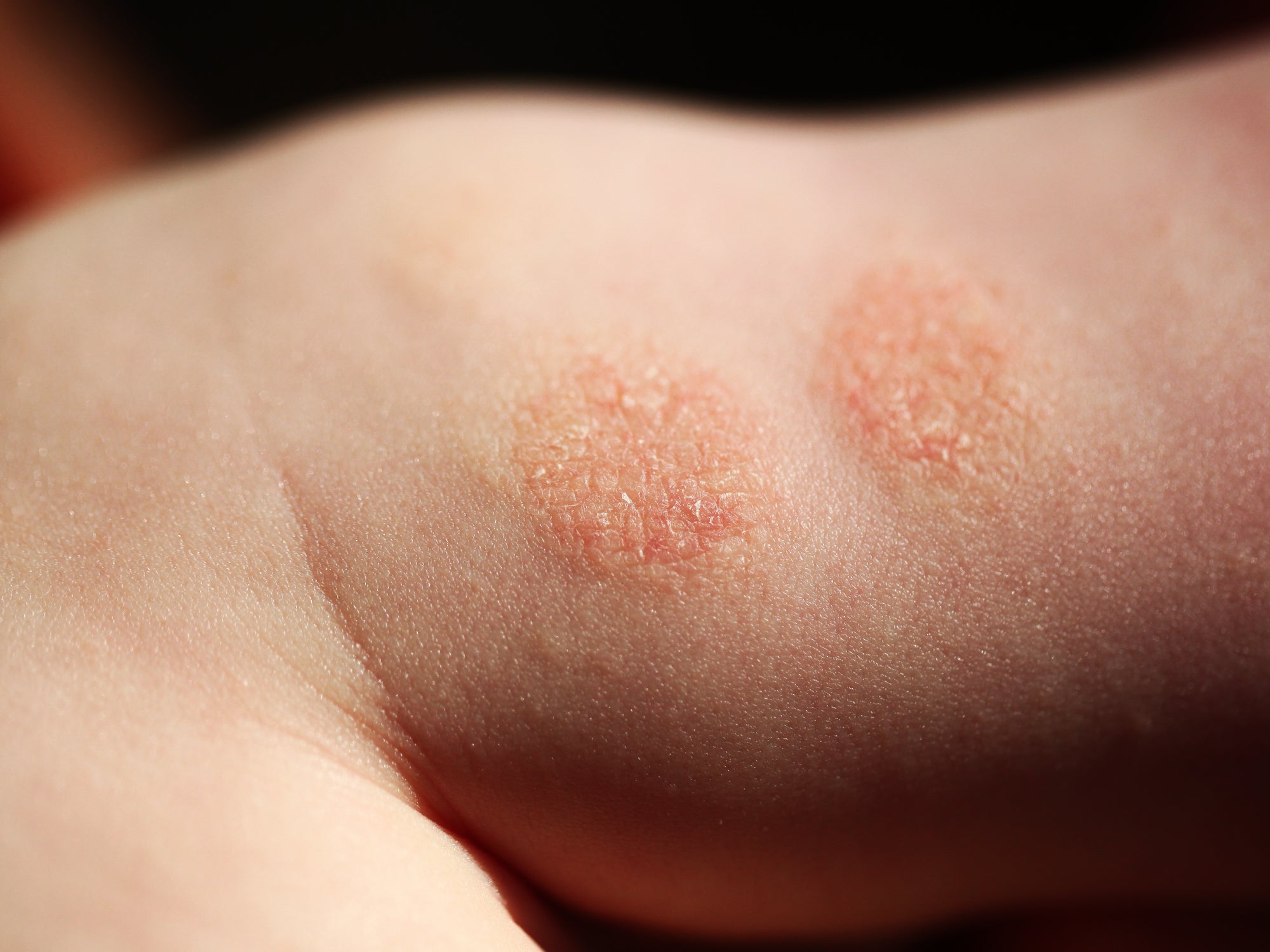 What Causes Discoid Dermatitis? – Balmonds