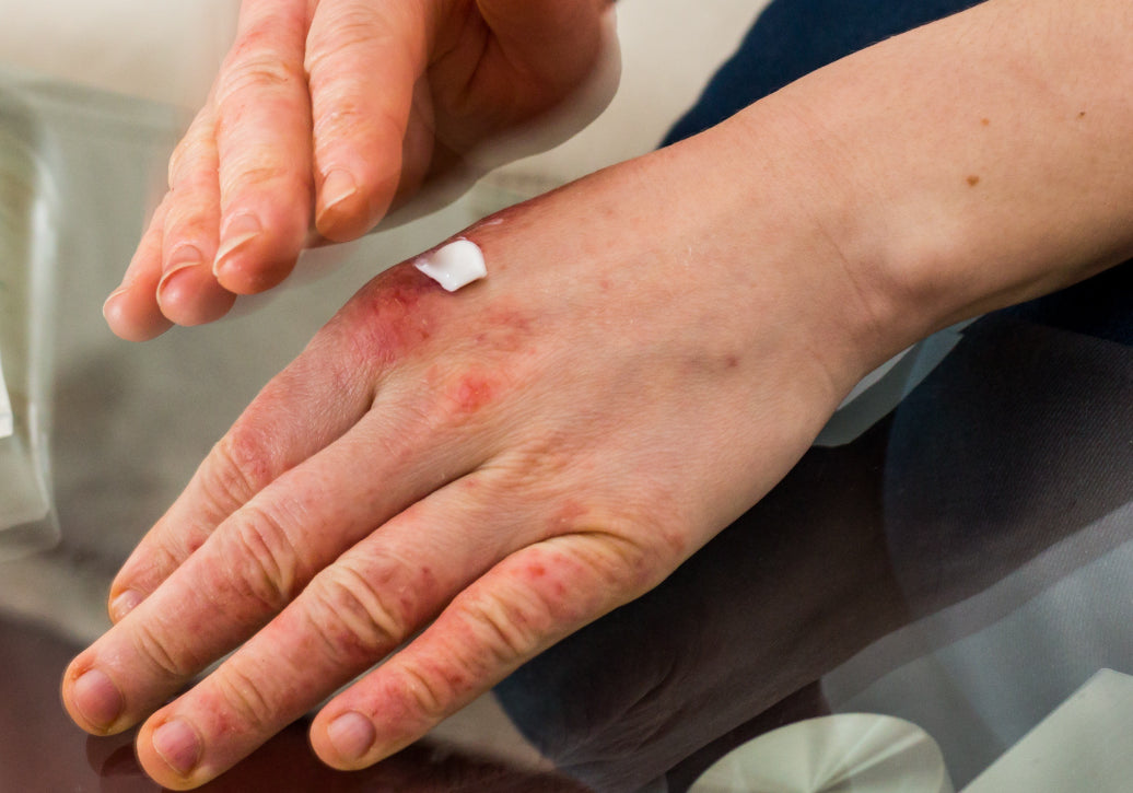Applying cream to Dyshidrotic Eczema on the back of a hand