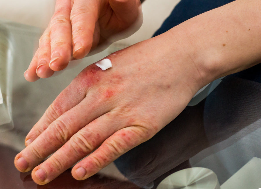 Applying cream to Dyshidrotic Eczema on the back of a hand