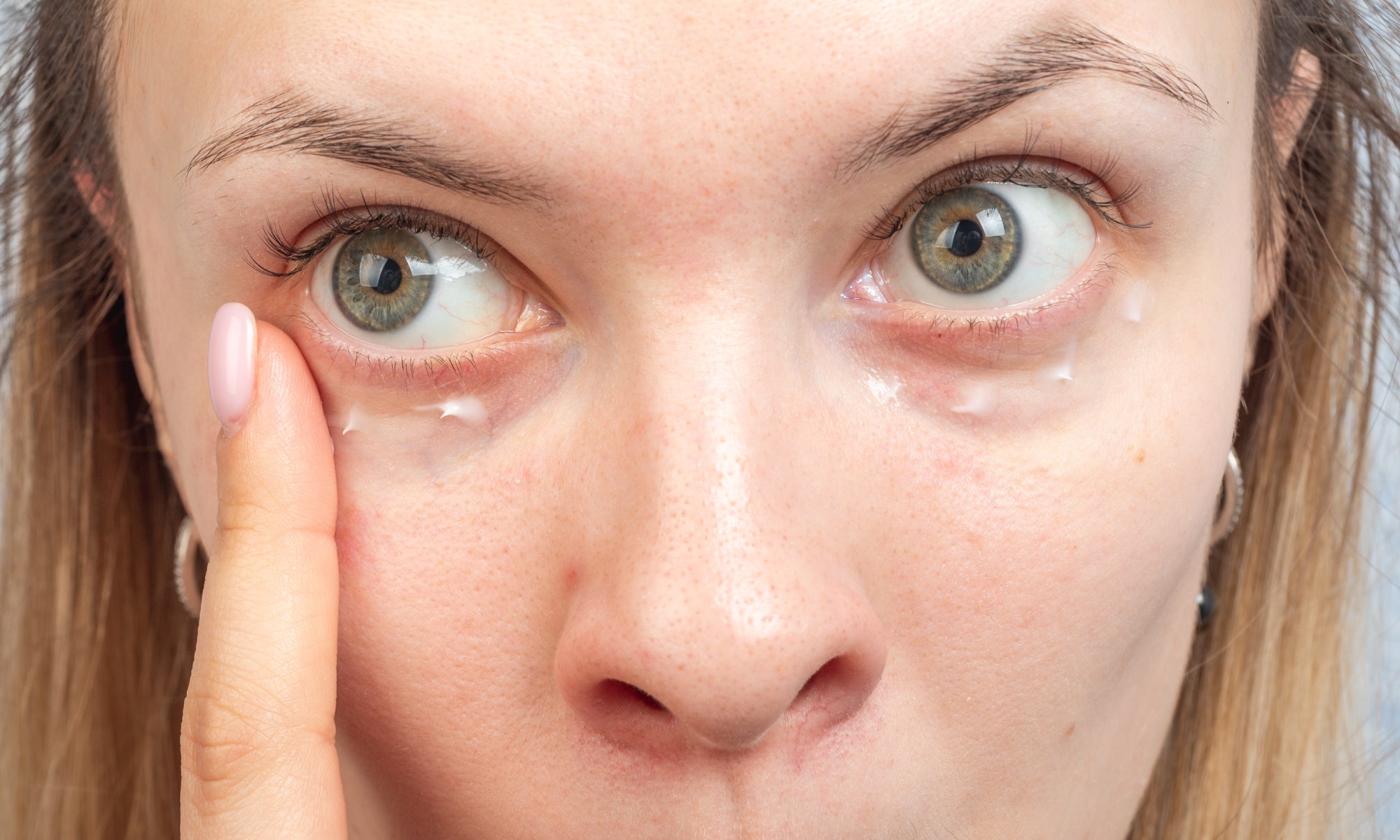 Applying cream to Periocular Dermatitis