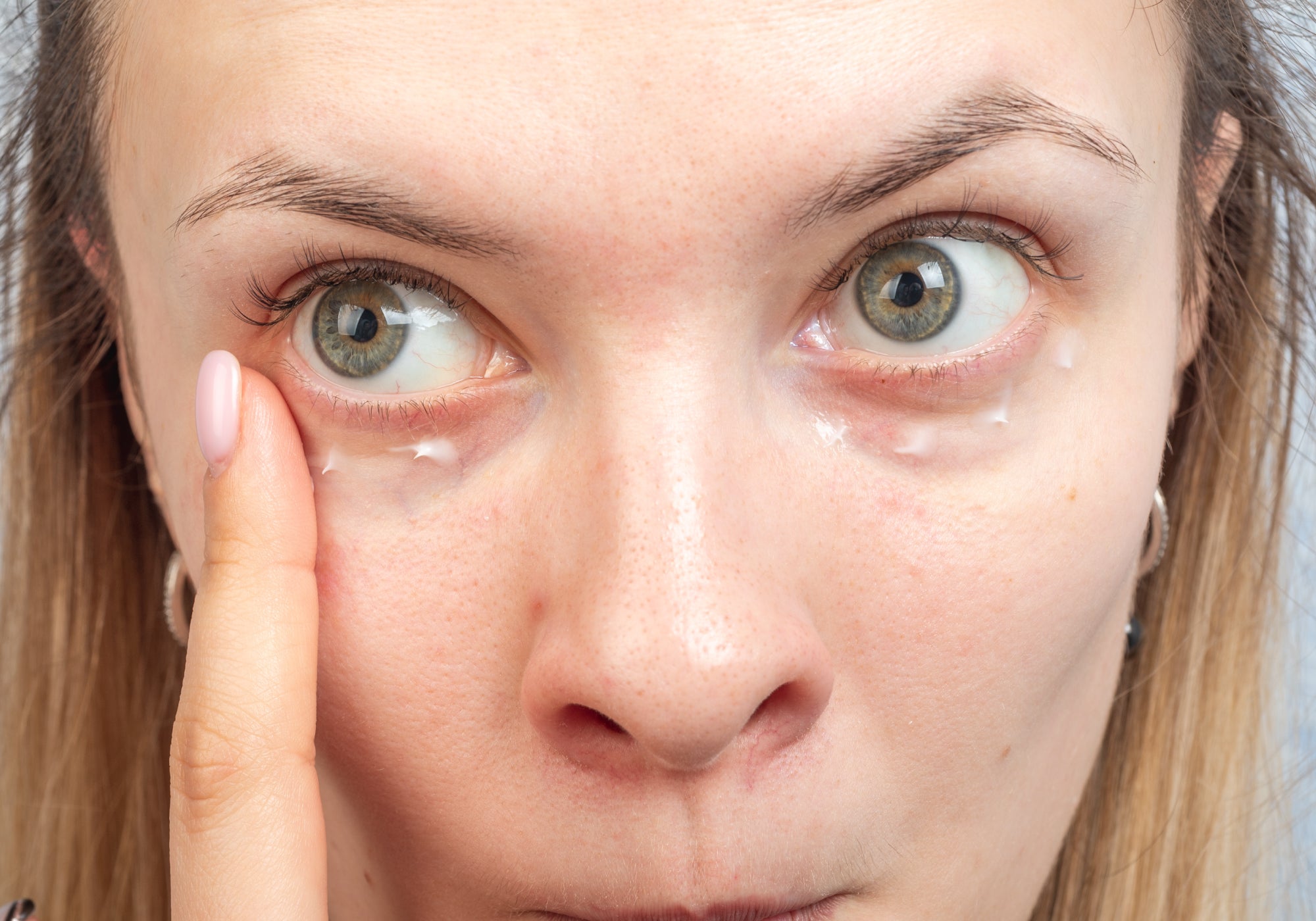 Applying cream to Periocular Dermatitis