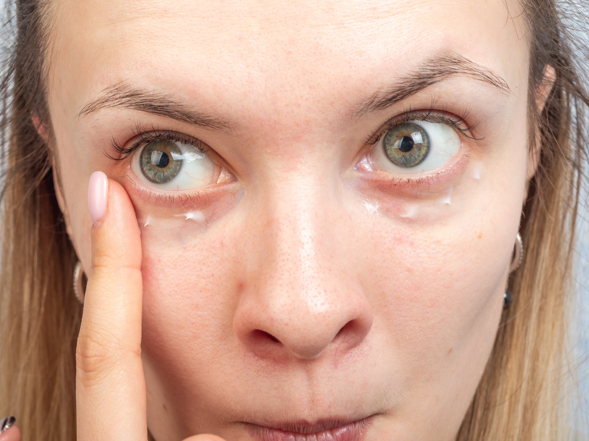 Applying cream to Periocular Dermatitis