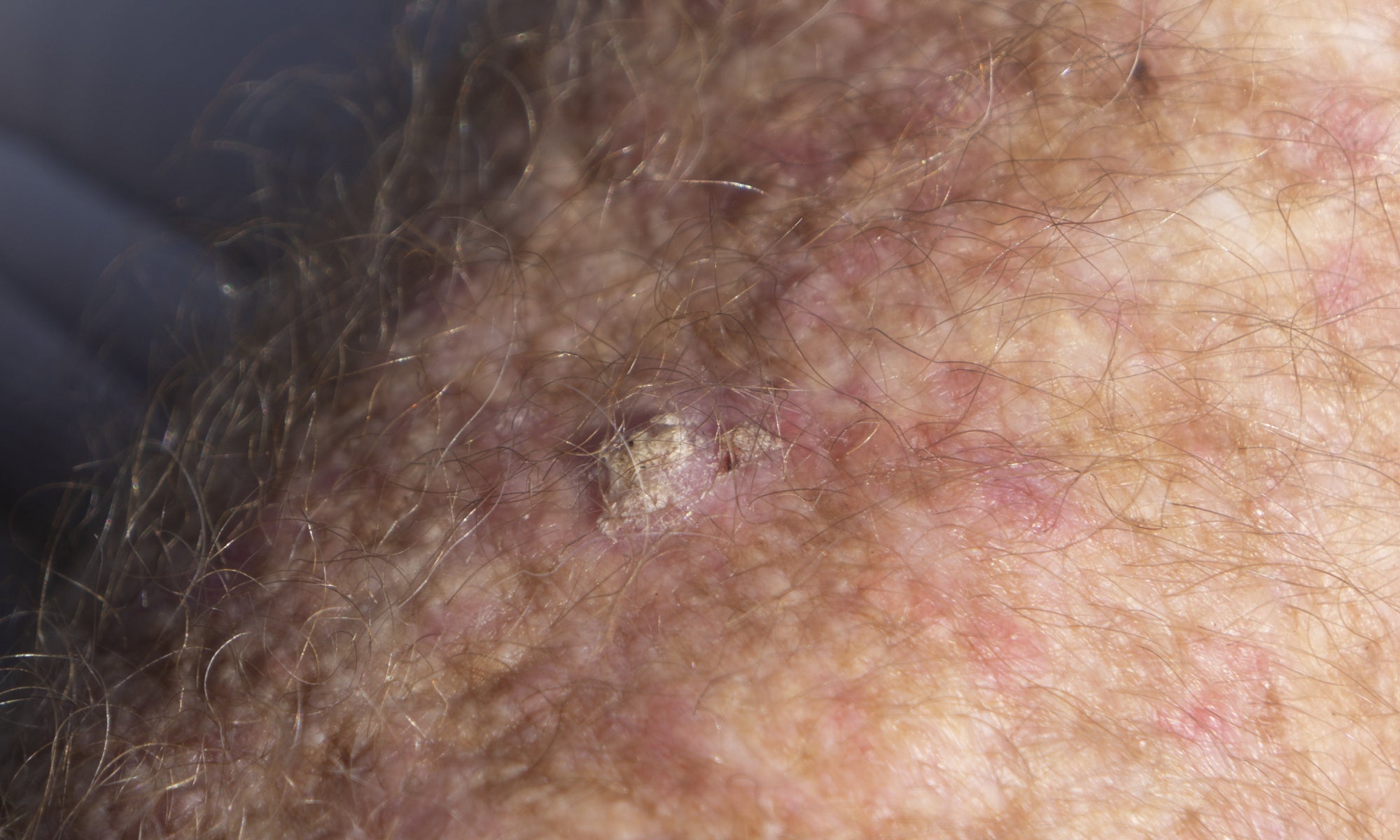 An example of Actinic Keratosis