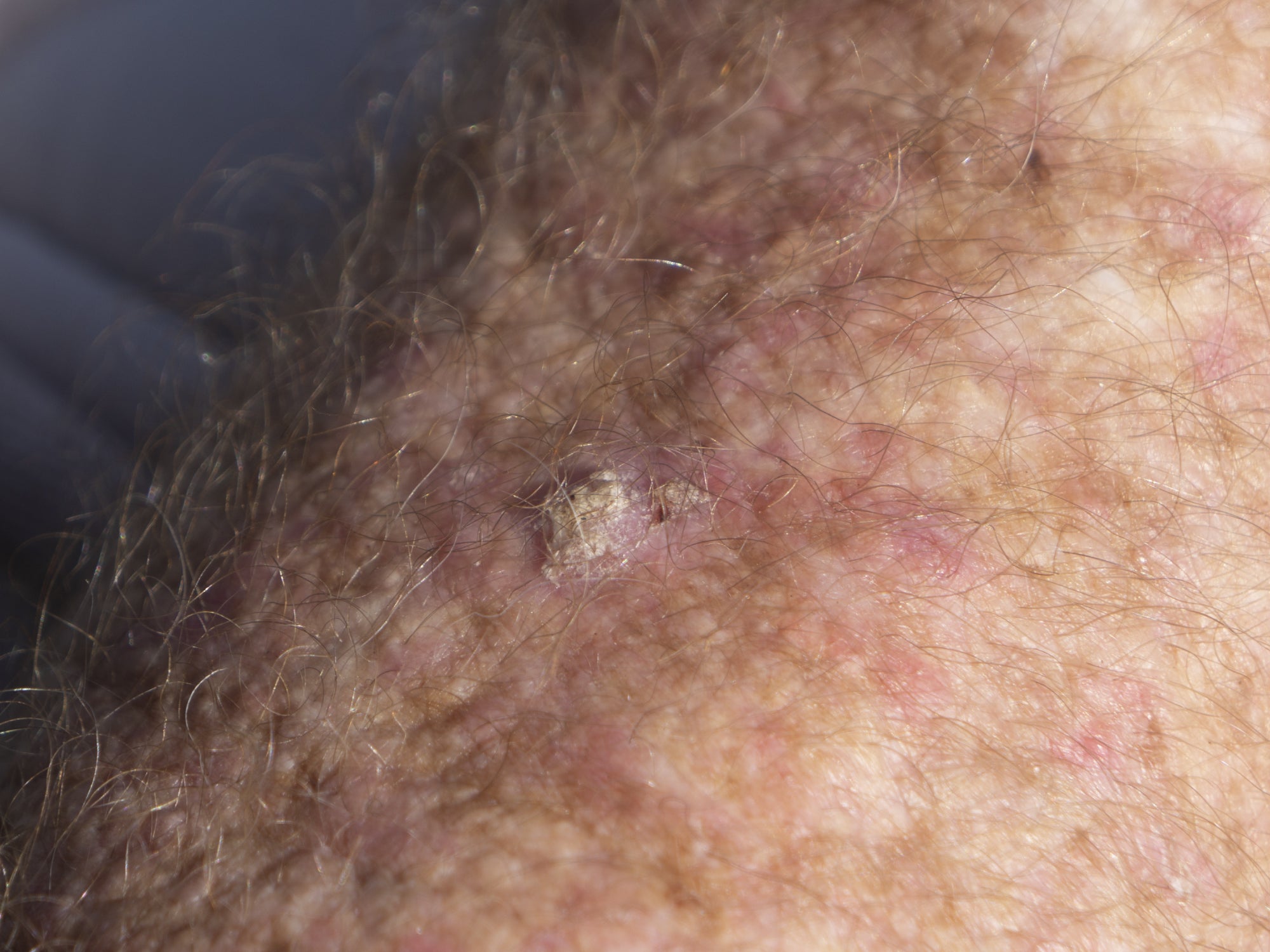 An example of Actinic Keratosis