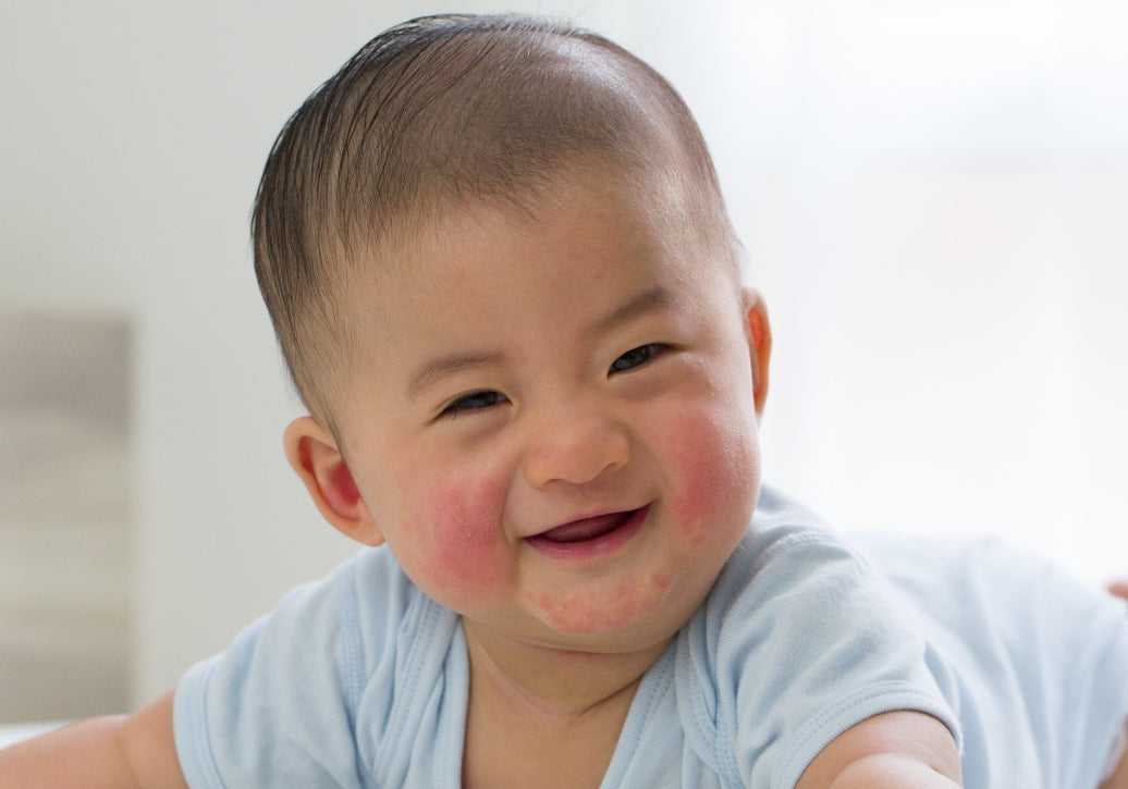 baby with eczema on cheeks